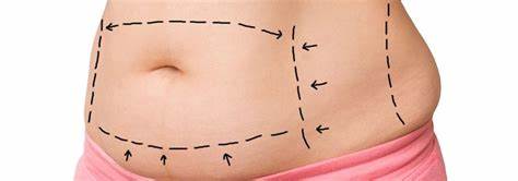 best tummy tuck in india